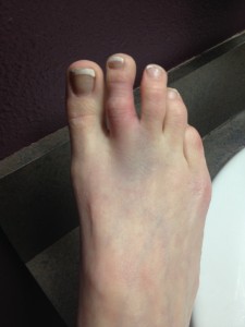 picture of broken toe